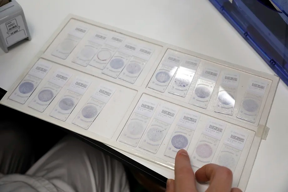 Analysis of cancer samples in the Pathological Anatomy service at the Ramn y Cajal University Hospital (Madrid).