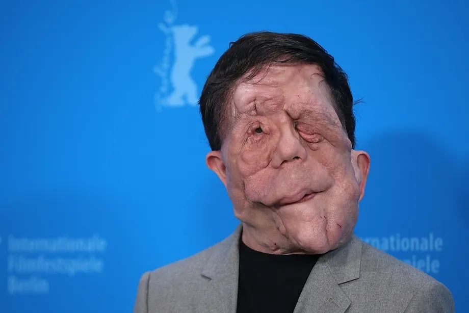 Actor Adam Pearson, protagonist of 'A Different Man'.