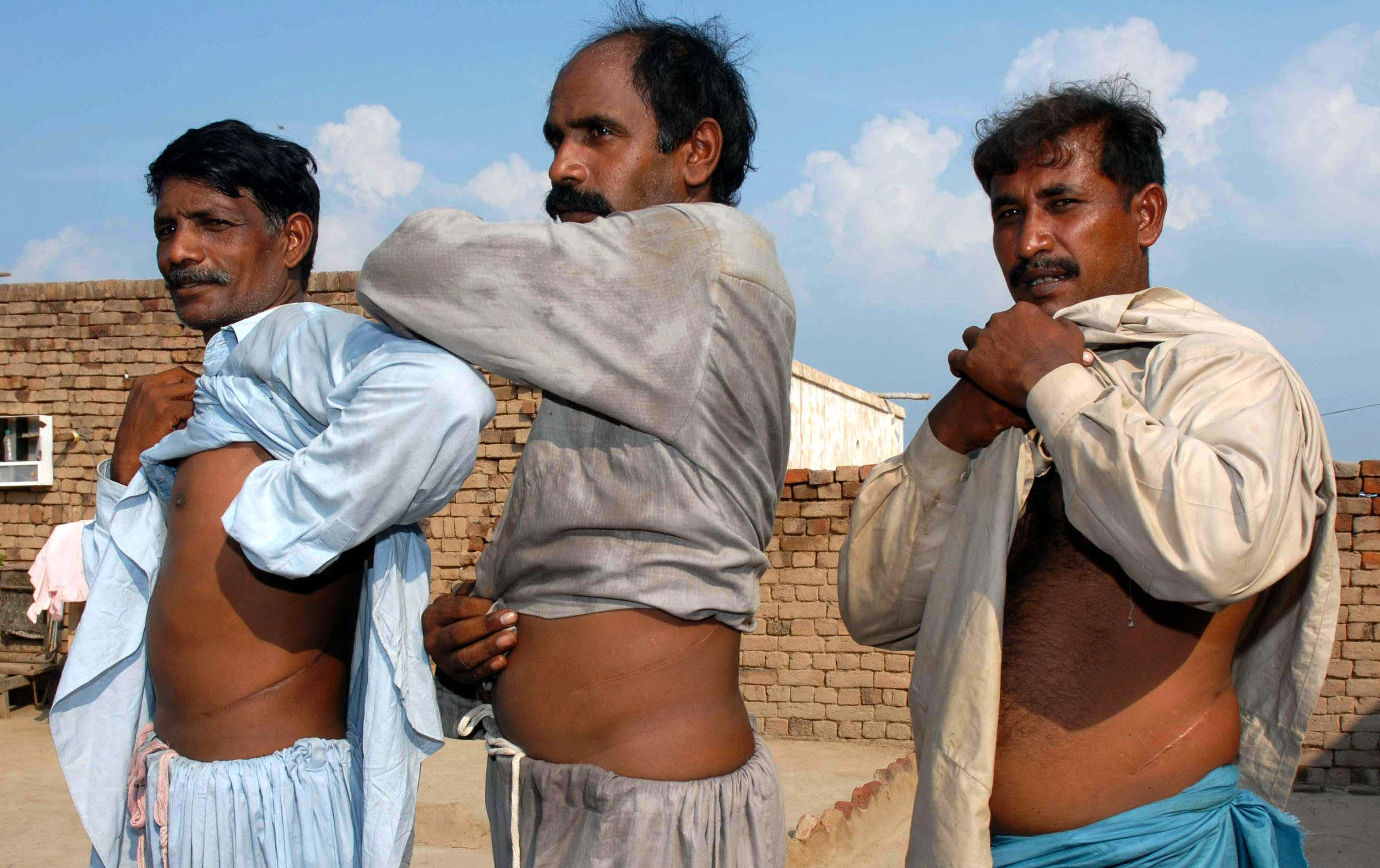 Three farmers in Pakistan sold one of their kidneys and show off their scars.