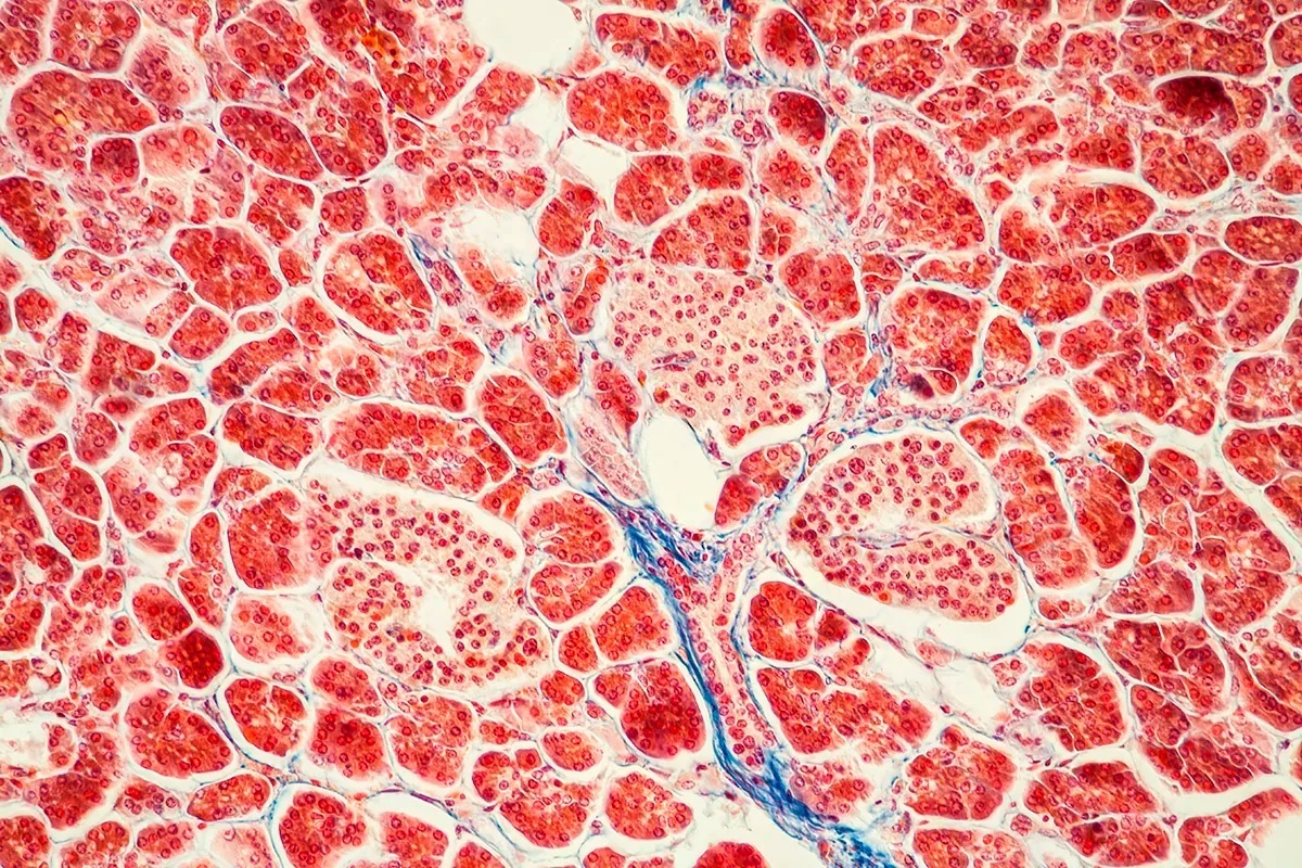 Pancreatic cancer: the hidden tumor that grows silently due to Risk factors such as obesity and smoking