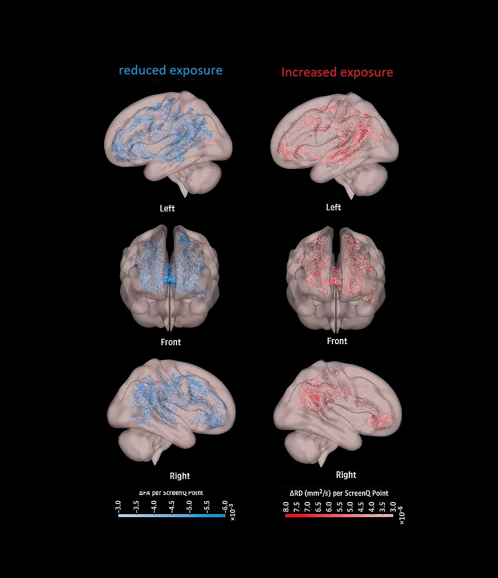 Magnetic resonance imaging reflecting low and high screen exposure on neuronal connections.