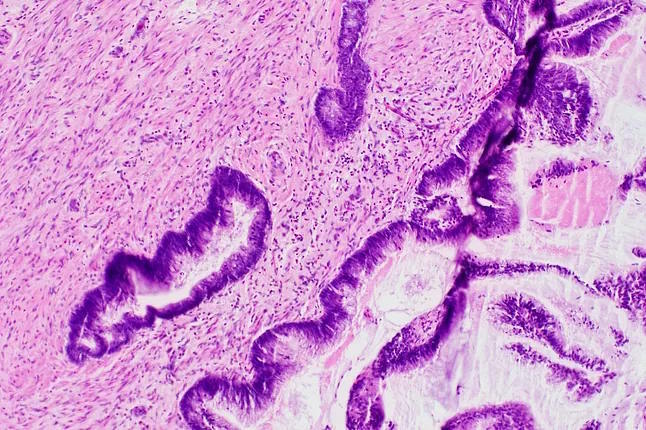 Microscopic study of a tumor with mucus in the appendix.