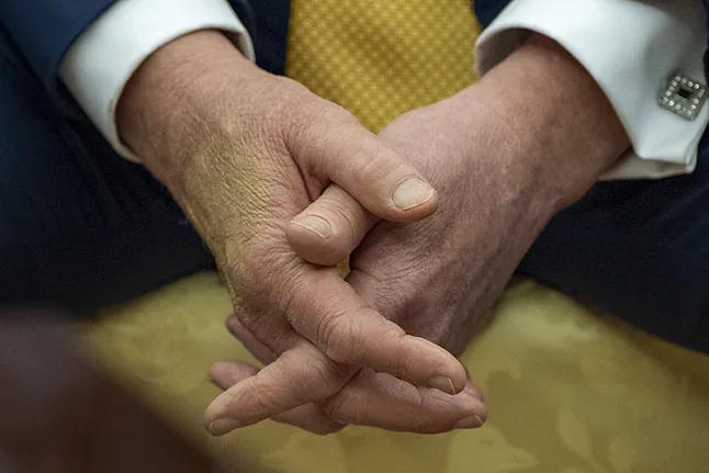 Trump's bruised hands that raised the first alarms.