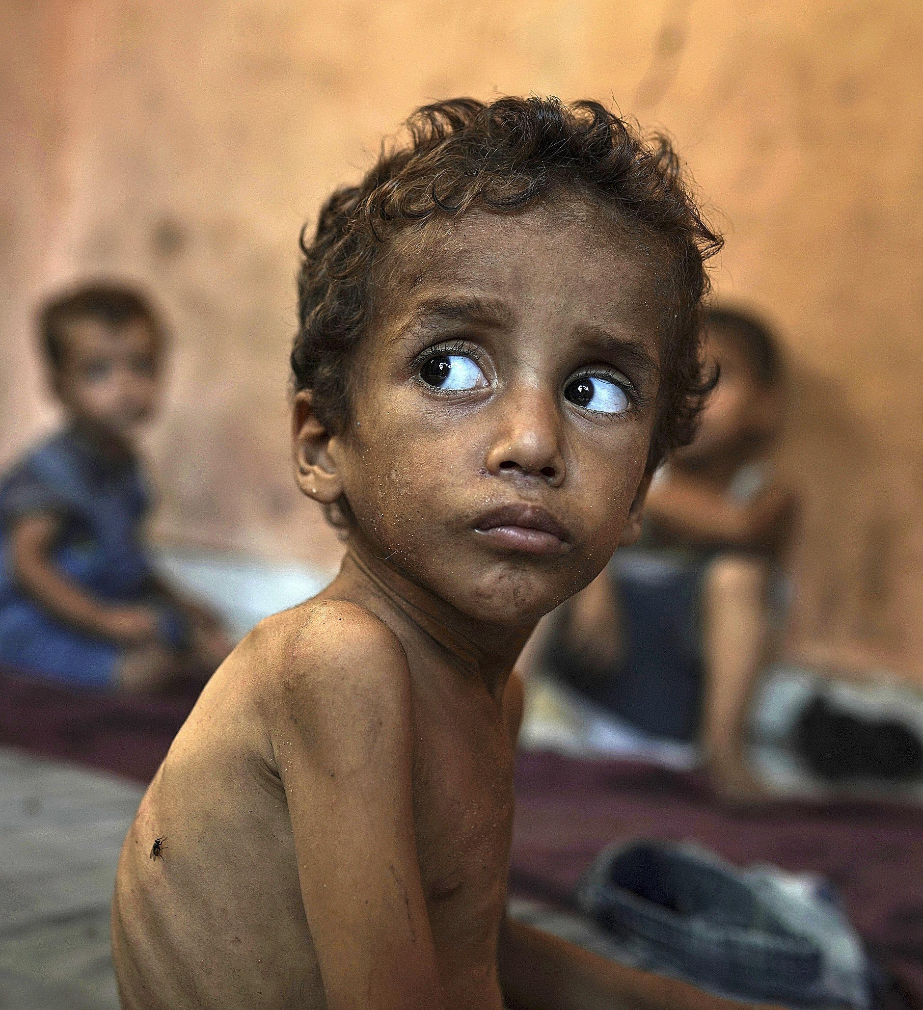 Yazan Abu Ful, a 2-year-old malnourished child, in refugee camp in Gaza.