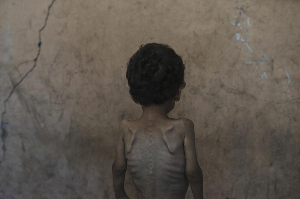 Yazan Abu Ful, a malnourished 2-year-old boy.