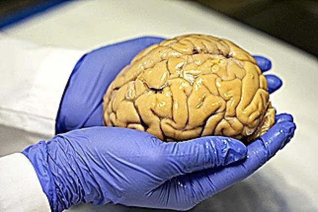 A brain donated to the Brain Bank of the Cien-Reina Sofa Foundation.