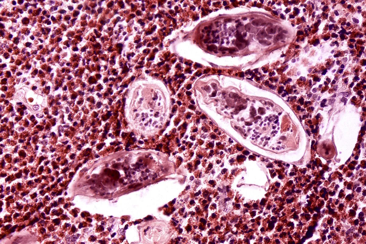 Parasitic infection is spreading due to globalization and climate change.