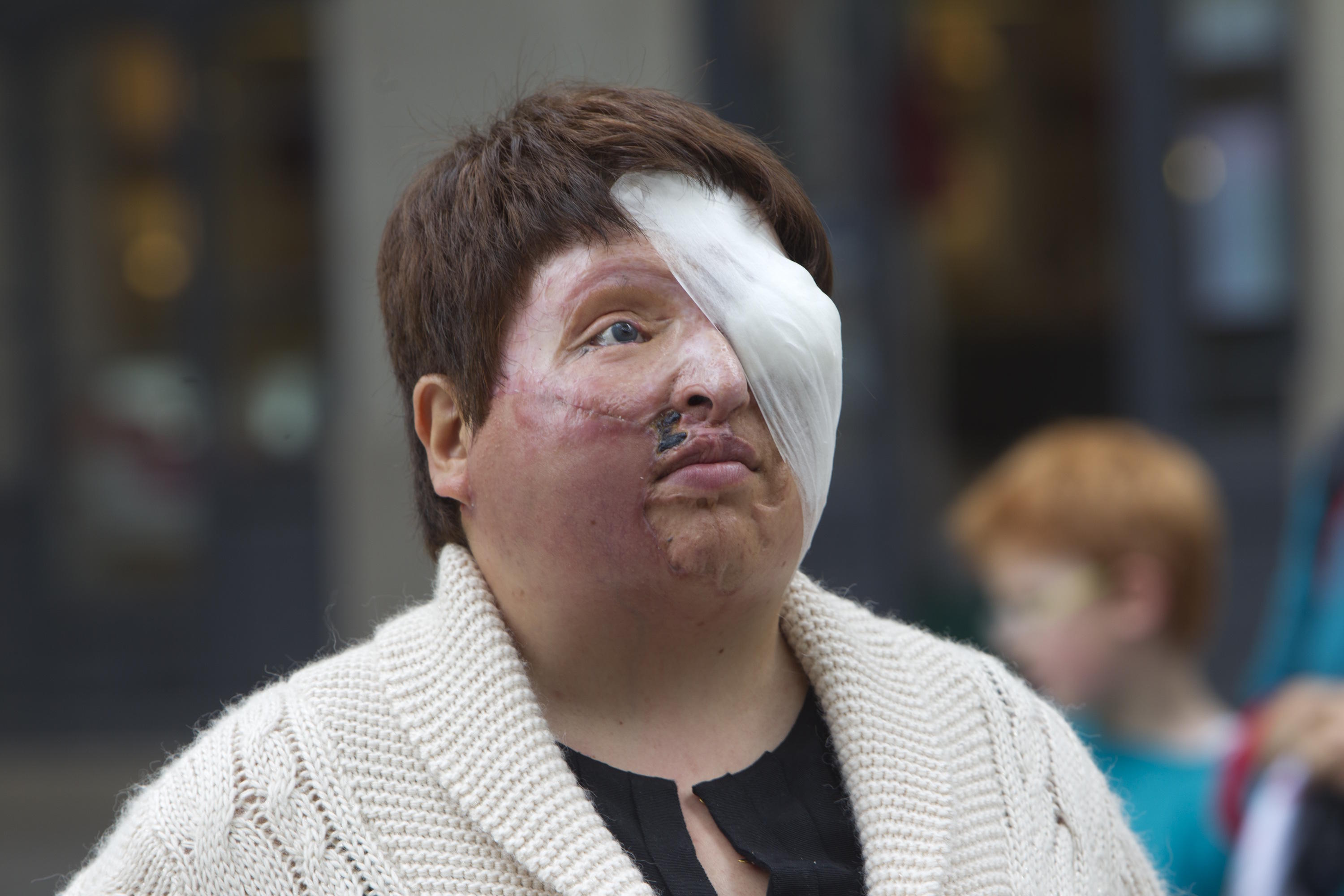 The Iranian woman blinded and disfigured by acid in 2012.