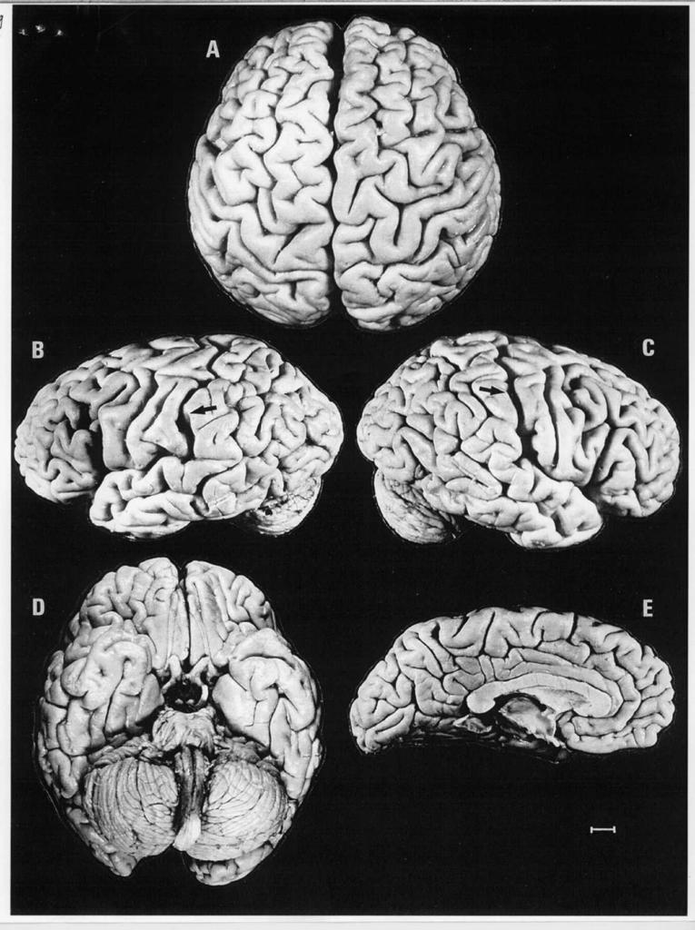 Albert Einstein's brain.