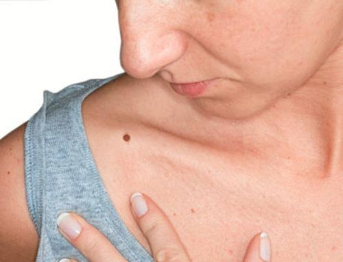 A woman with a mole.