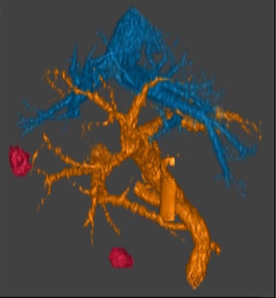 Image of a pancreatic cancer cell.