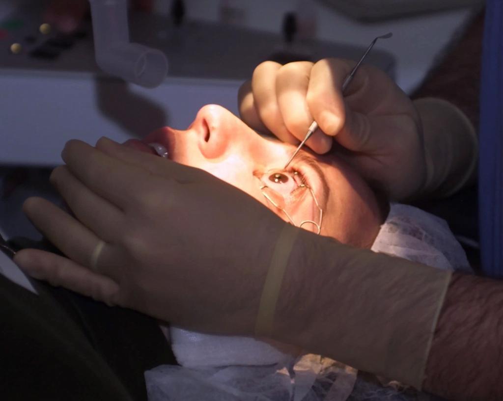 Image of laser eye surgery in Cincinnati.